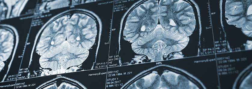 Traumatic Brain X-Ray