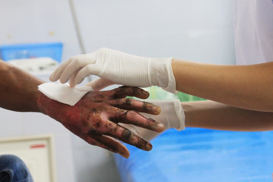 nurse addressing a burn wound