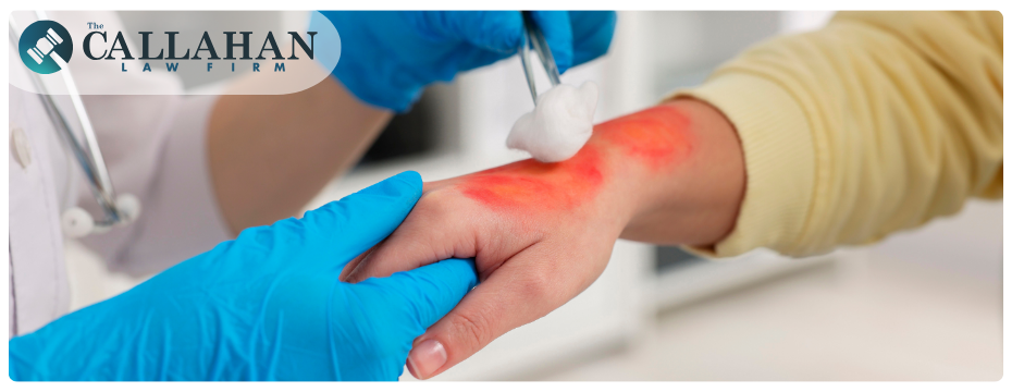 Houston Burn Injury Lawyer
